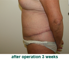 plastic-surgery-tummy-tuck